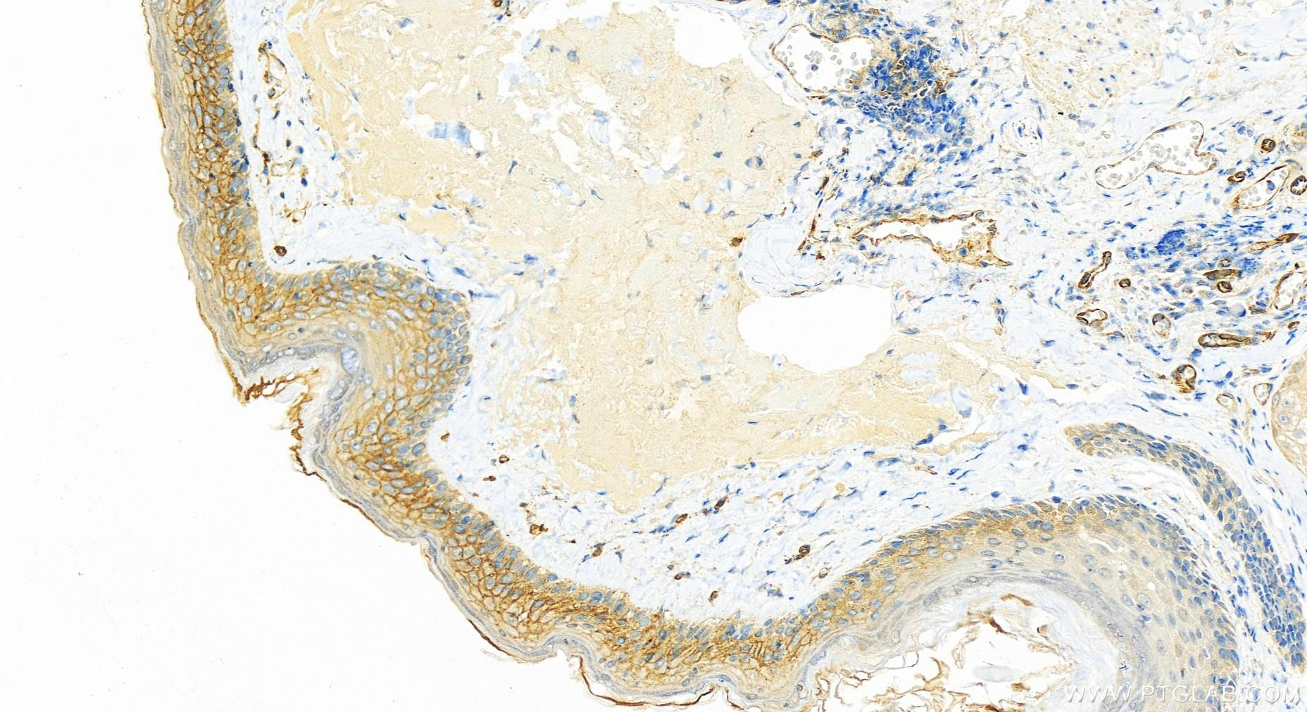 IHC staining of human skin cancer using 14318-1-AP