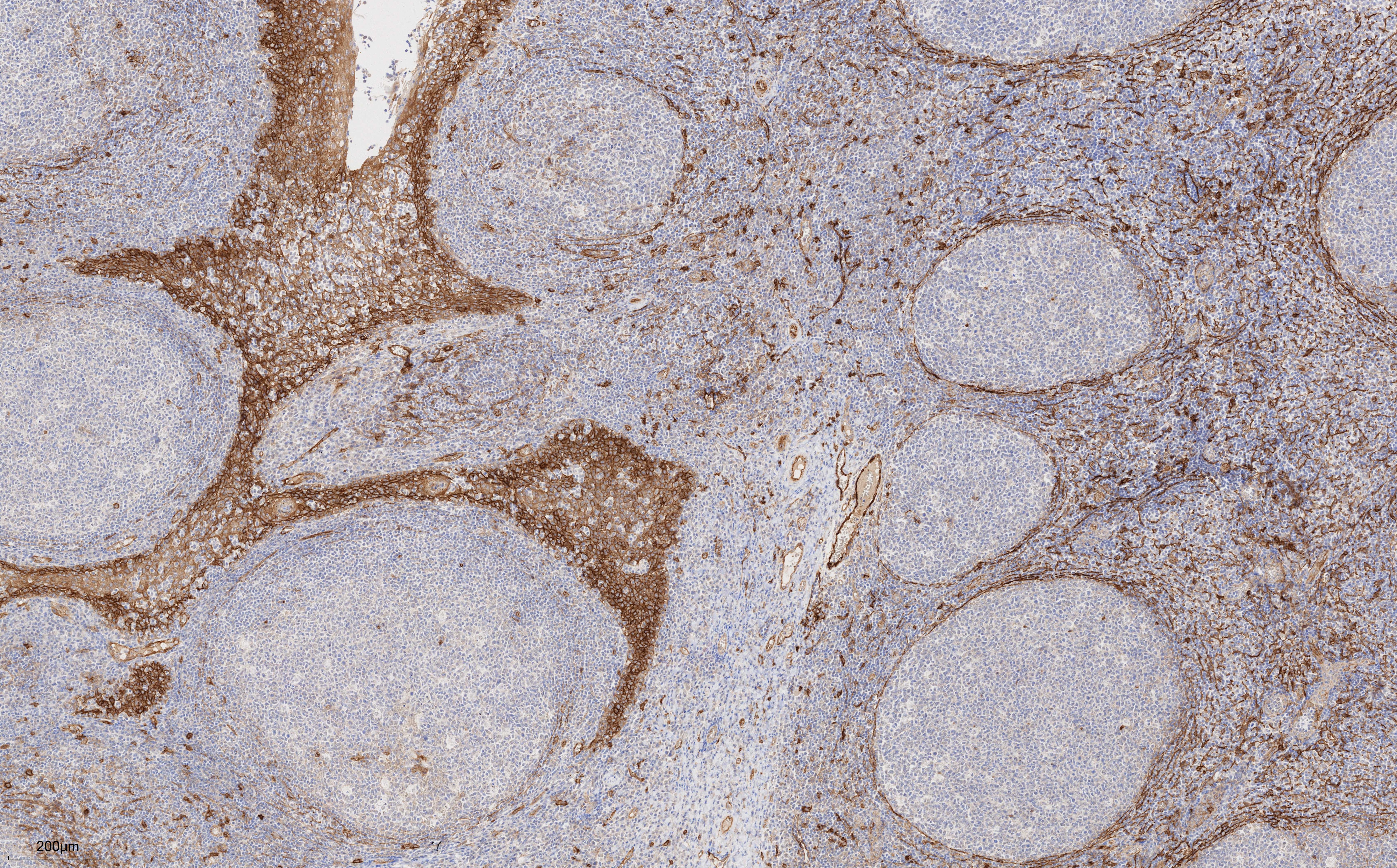 IHC staining of human tonsillitis using 67831-1-Ig