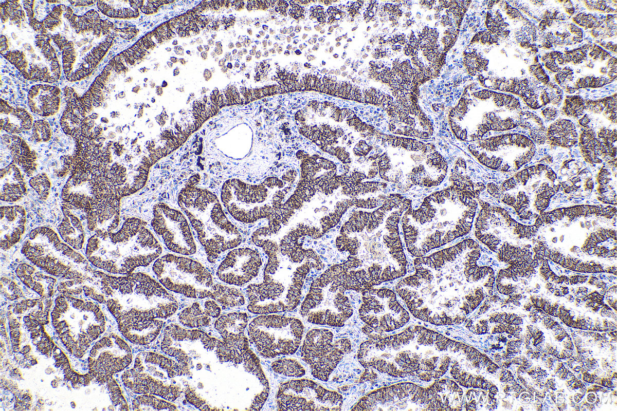 IHC staining of human lung cancer using 16782-1-AP