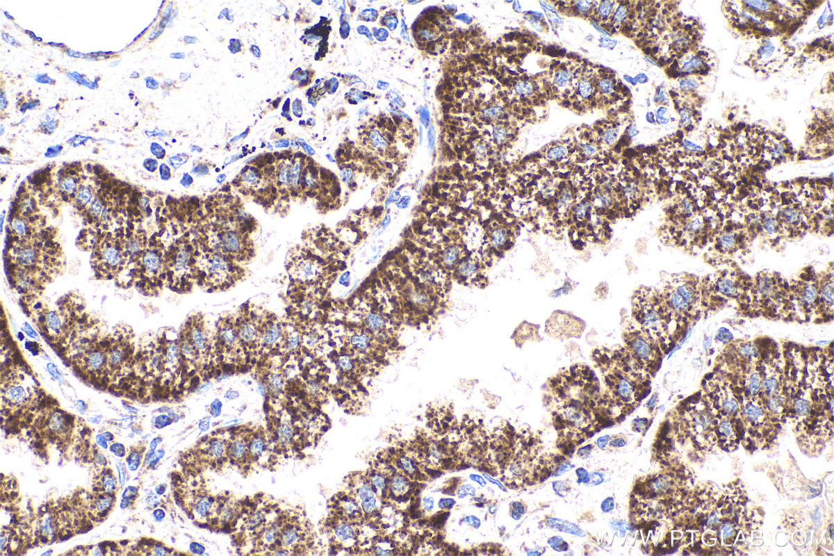 IHC staining of human lung cancer using 16782-1-AP