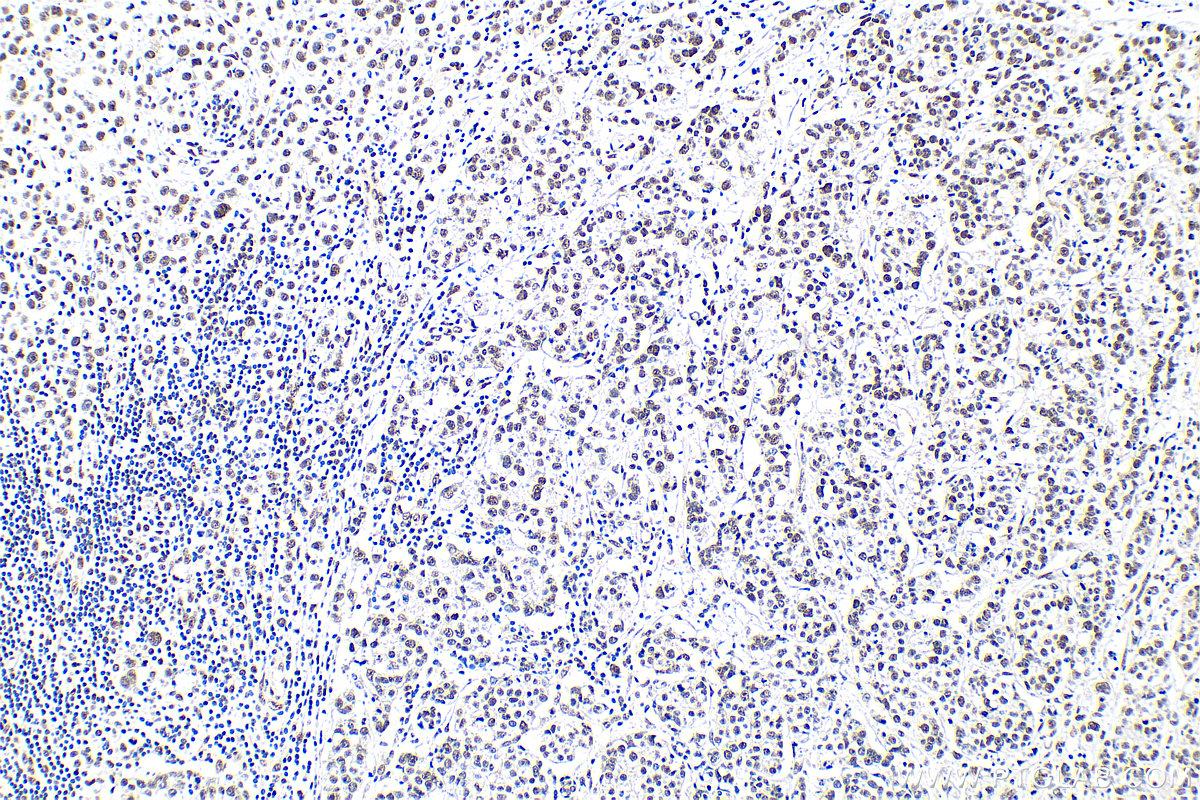 IHC staining of human breast cancer using 14862-1-AP