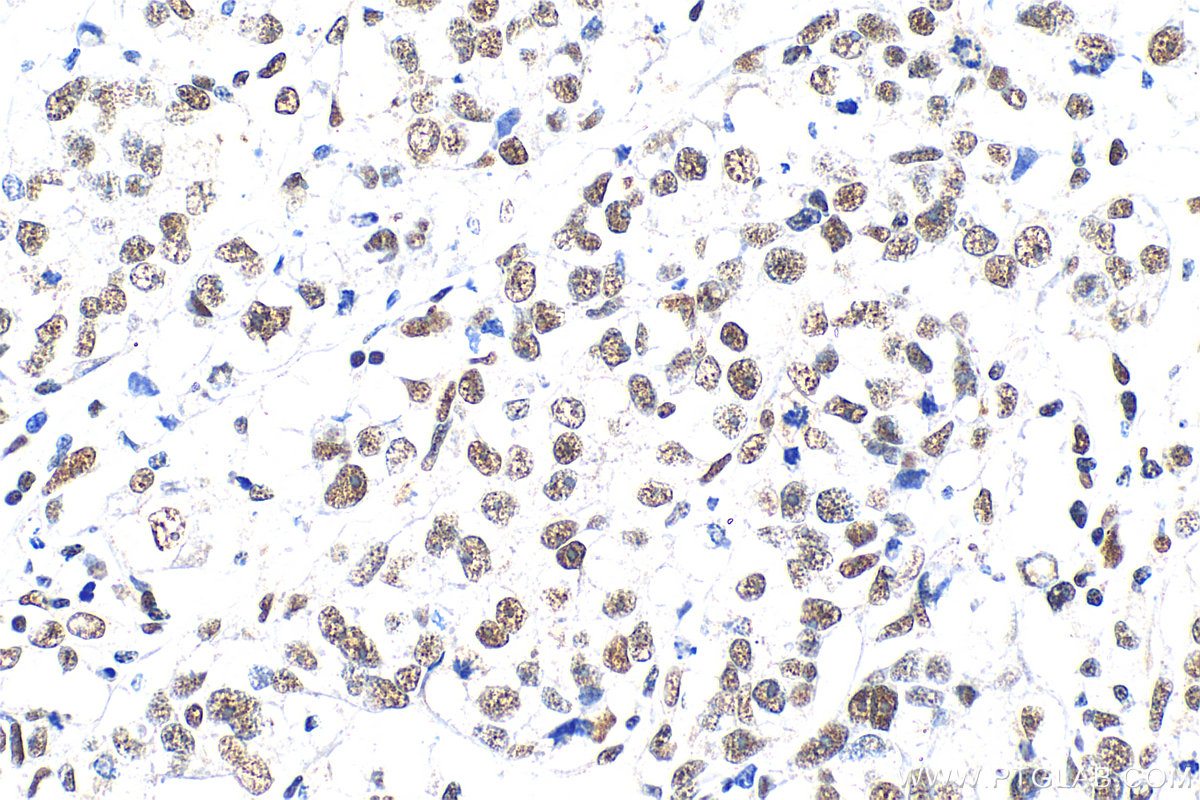 IHC staining of human breast cancer using 14862-1-AP