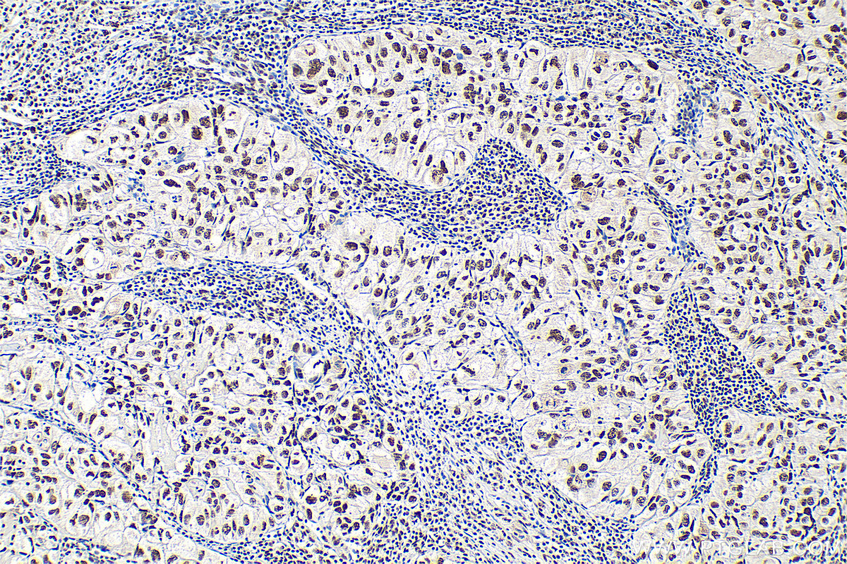 IHC staining of human lung cancer using 14862-1-AP