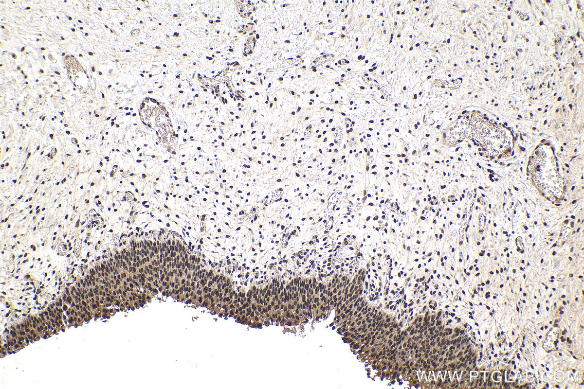 IHC staining of human urothelial carcinoma using 68486-1-Ig (same clone as 68486-1-PBS)