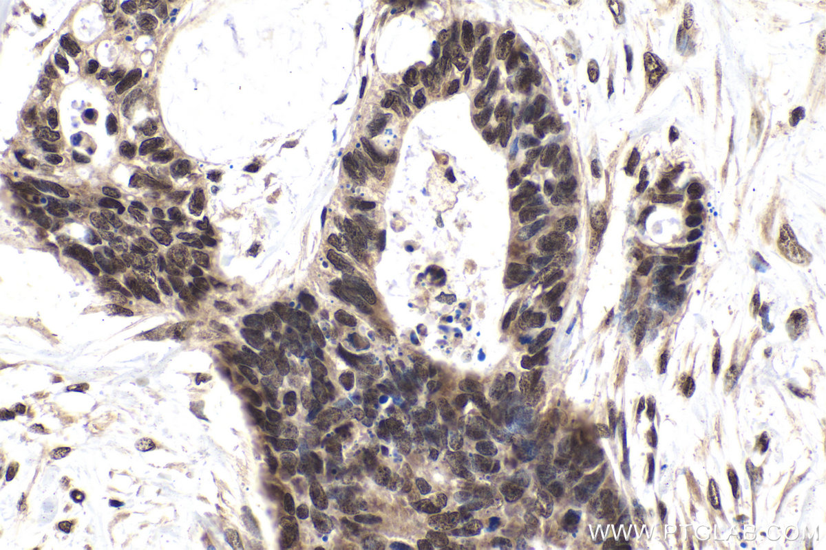 IHC staining of human urothelial carcinoma using 68486-1-Ig (same clone as 68486-1-PBS)