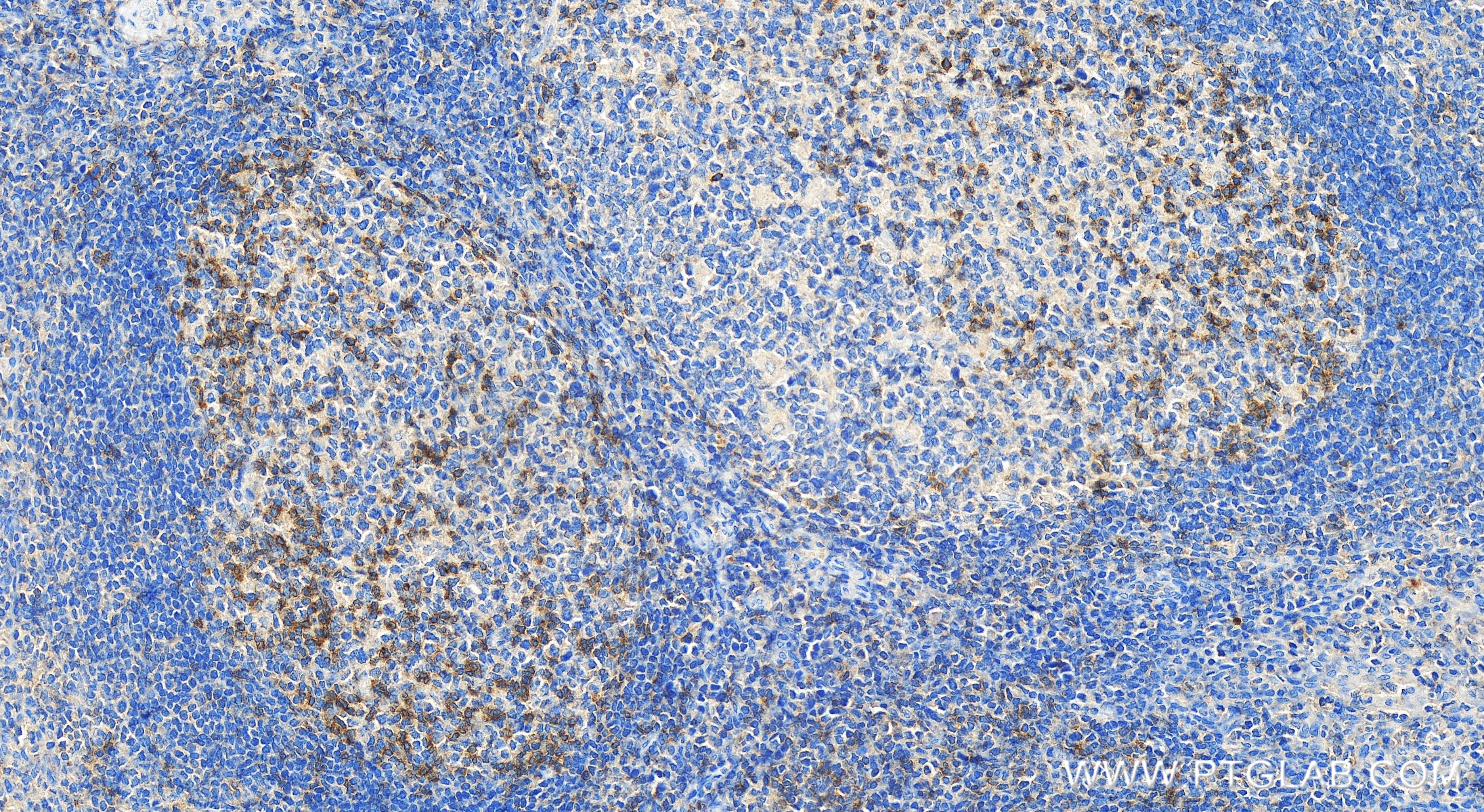 IHC staining of human tonsillitis using 83545-1-RR