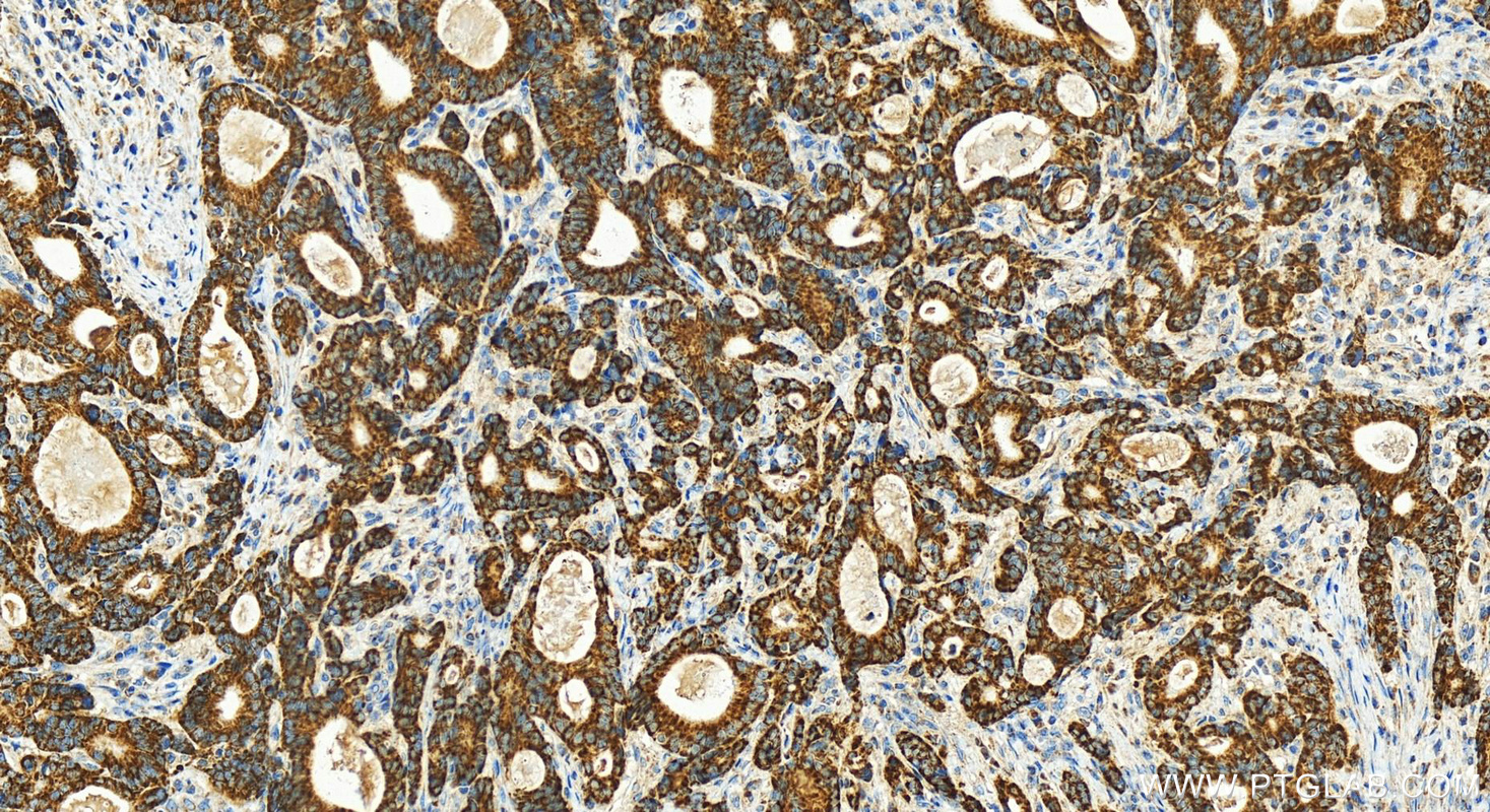 IHC staining of human stomach cancer using 11179-1-AP