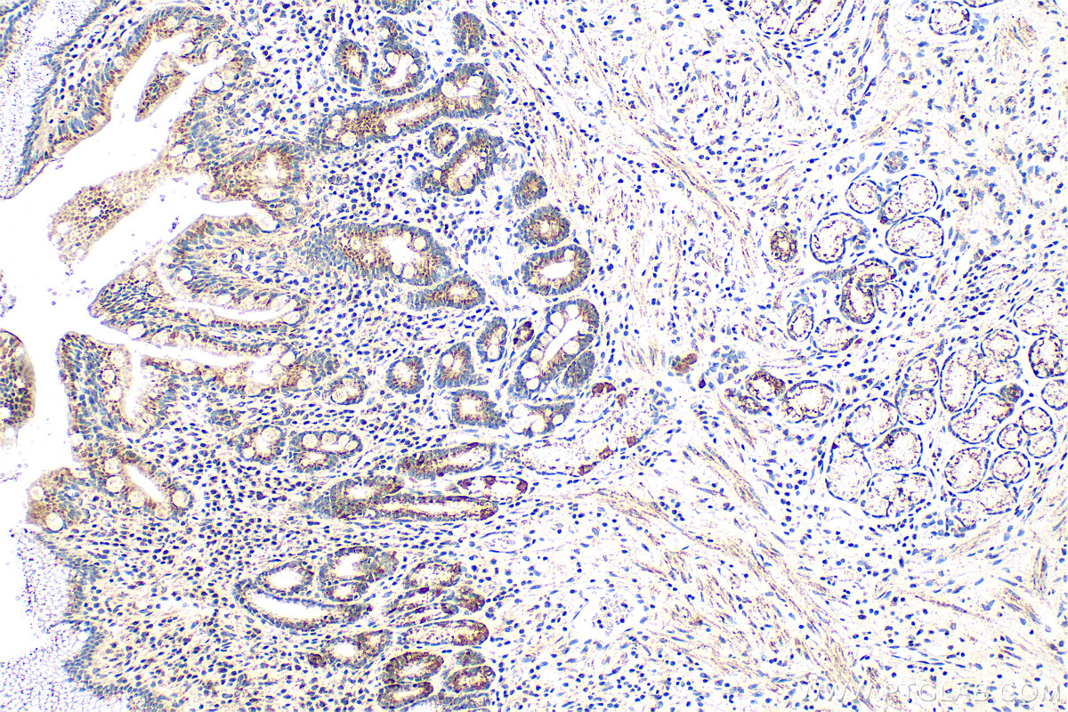 IHC staining of human stomach cancer using 11479-1-AP