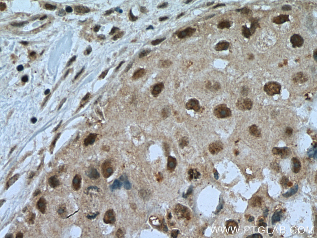 IHC staining of human breast cancer using 16230-1-AP