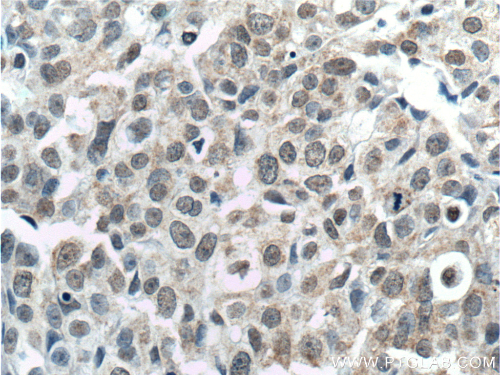 IHC staining of human breast cancer using 66374-1-Ig (same clone as 66374-1-PBS)