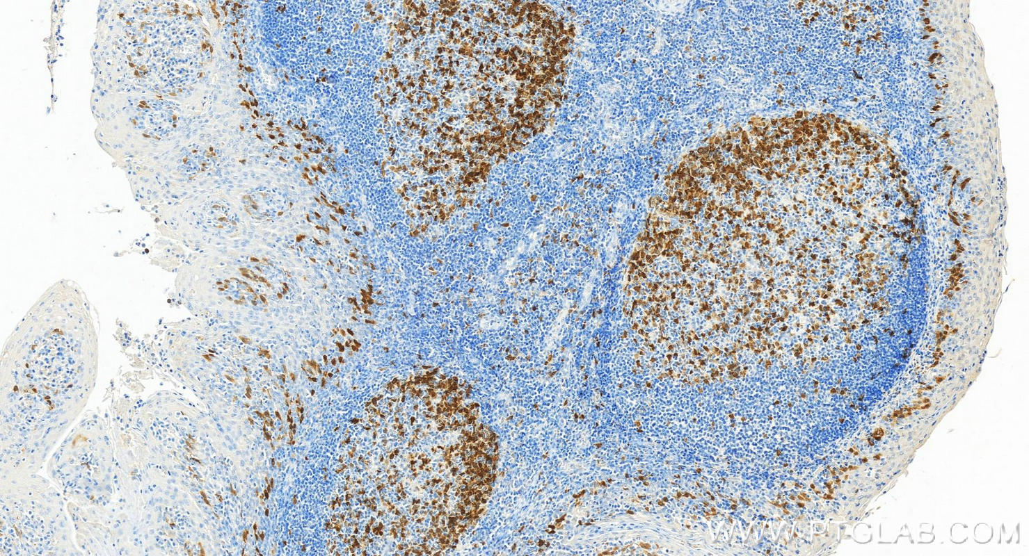 IHC staining of human tonsillitis using 67787-1-Ig