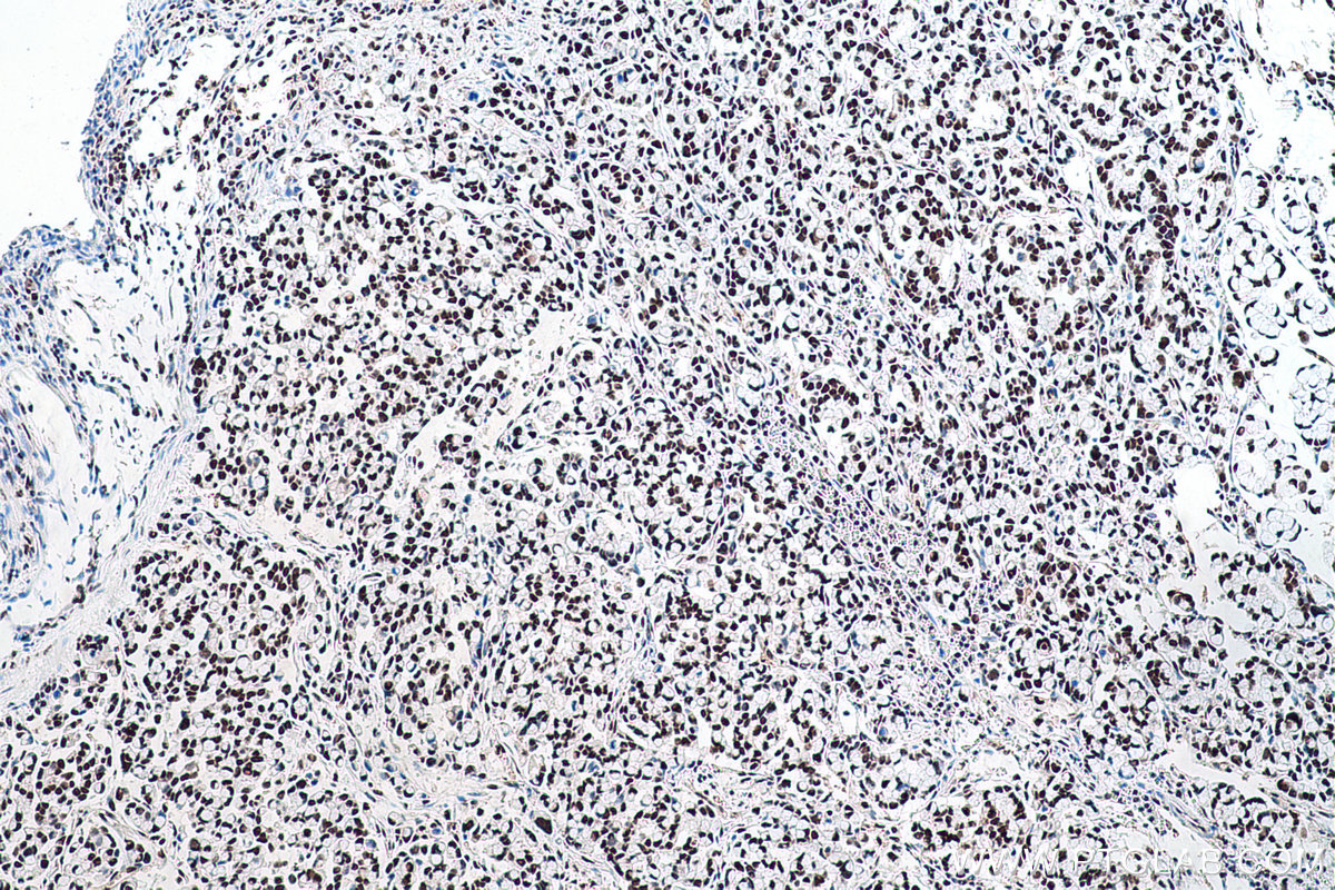 IHC staining of human colon cancer using 66016-1-Ig