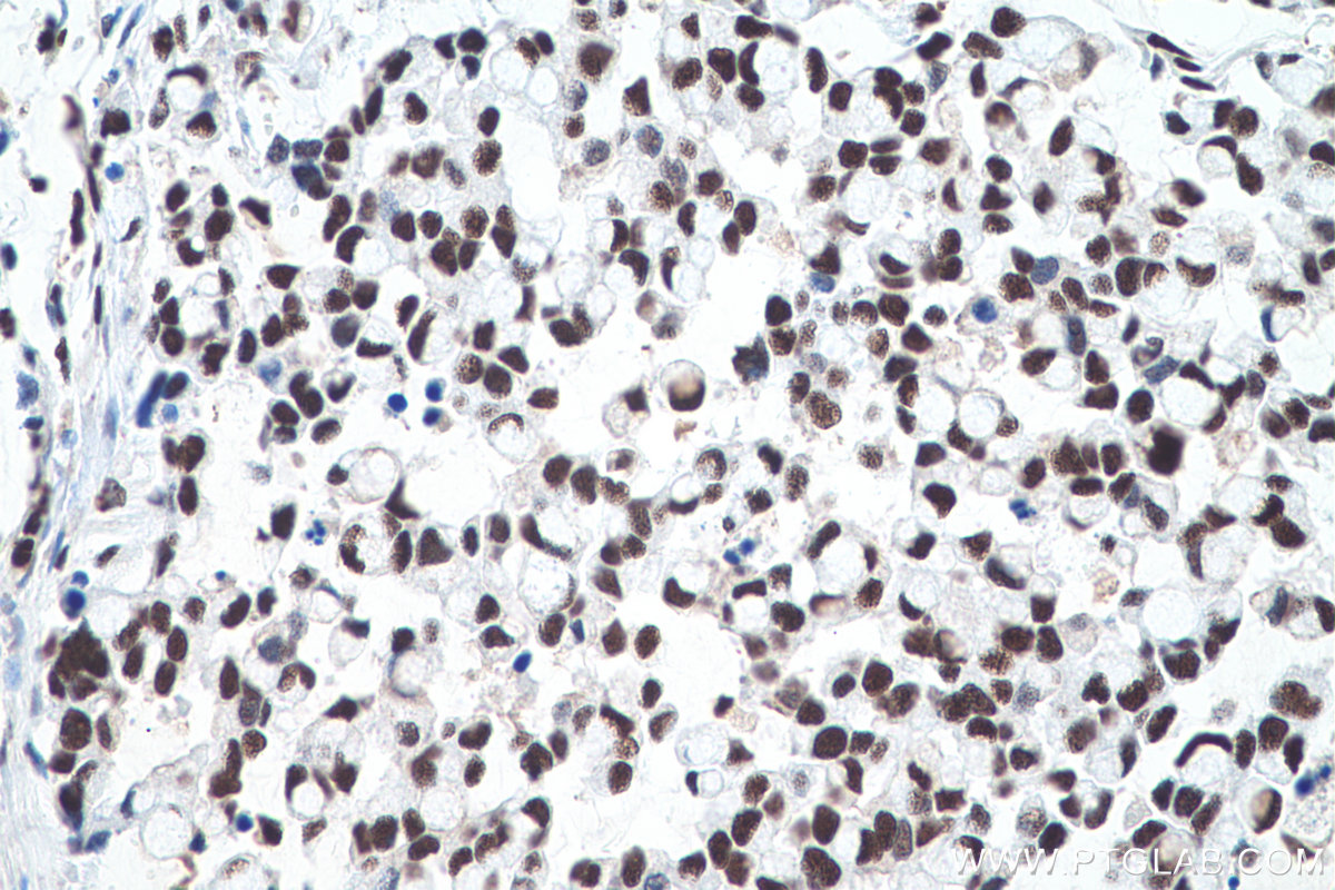 IHC staining of human colon cancer using 66016-1-Ig