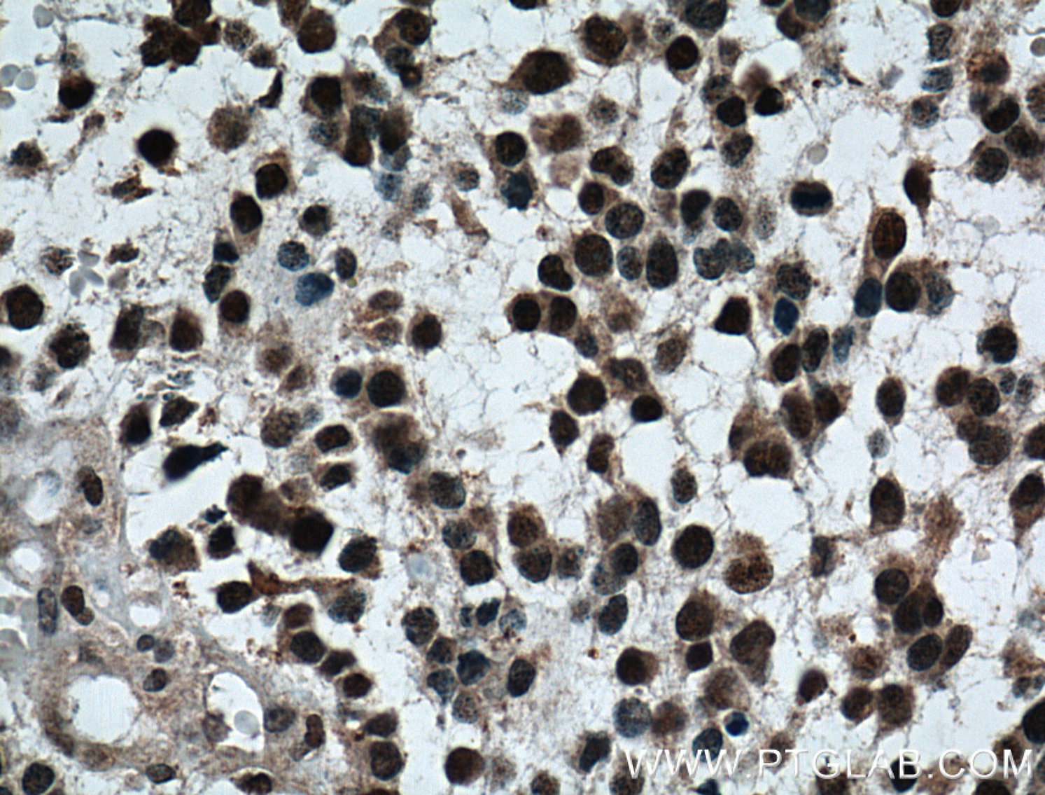 IHC staining of human gliomas using 66216-1-Ig (same clone as 66216-1-PBS)