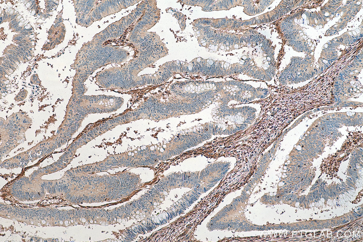 IHC staining of human colon cancer using 67992-1-Ig (same clone as 67992-1-PBS)