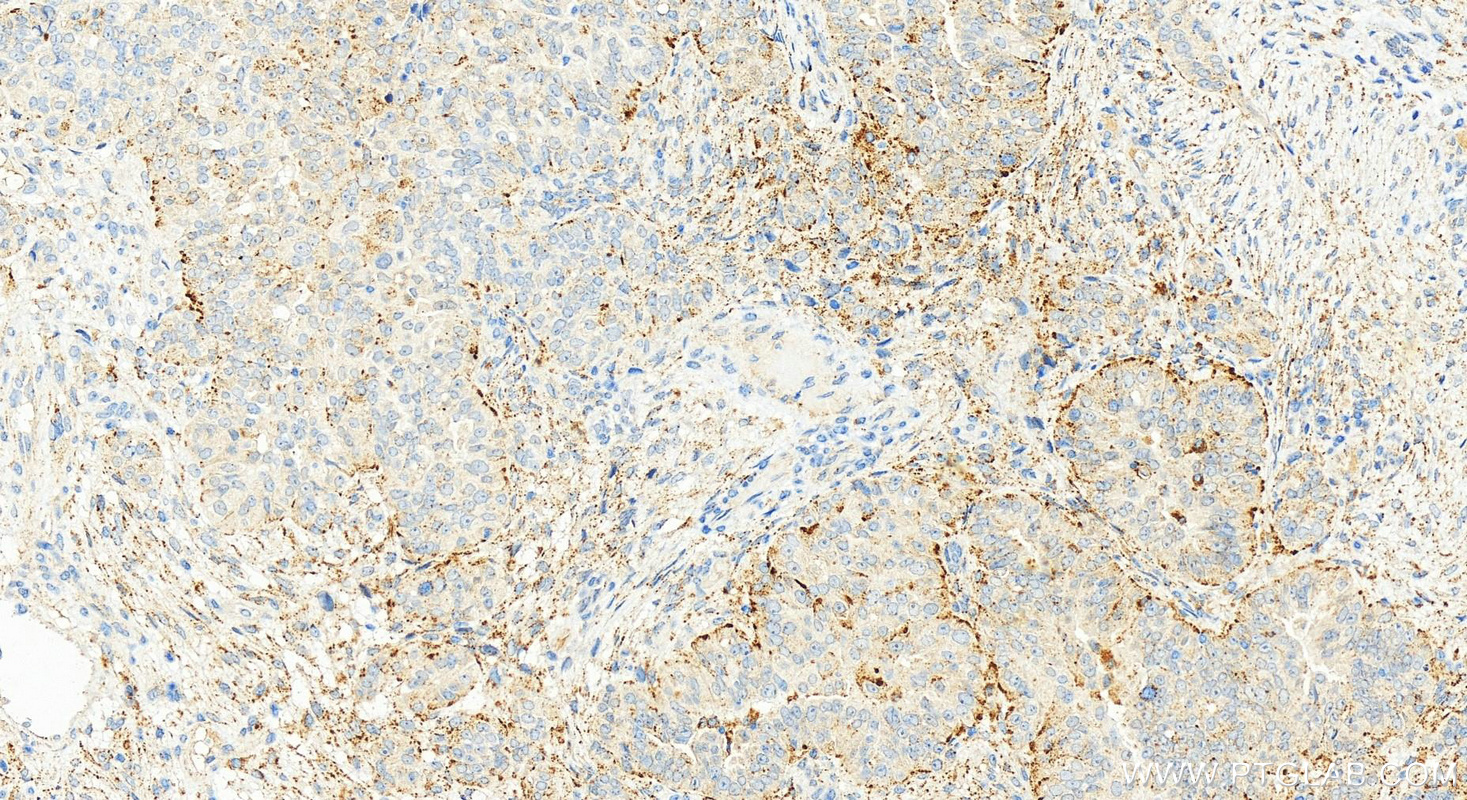 IHC staining of human ovarian  cancer using 83136-3-RR