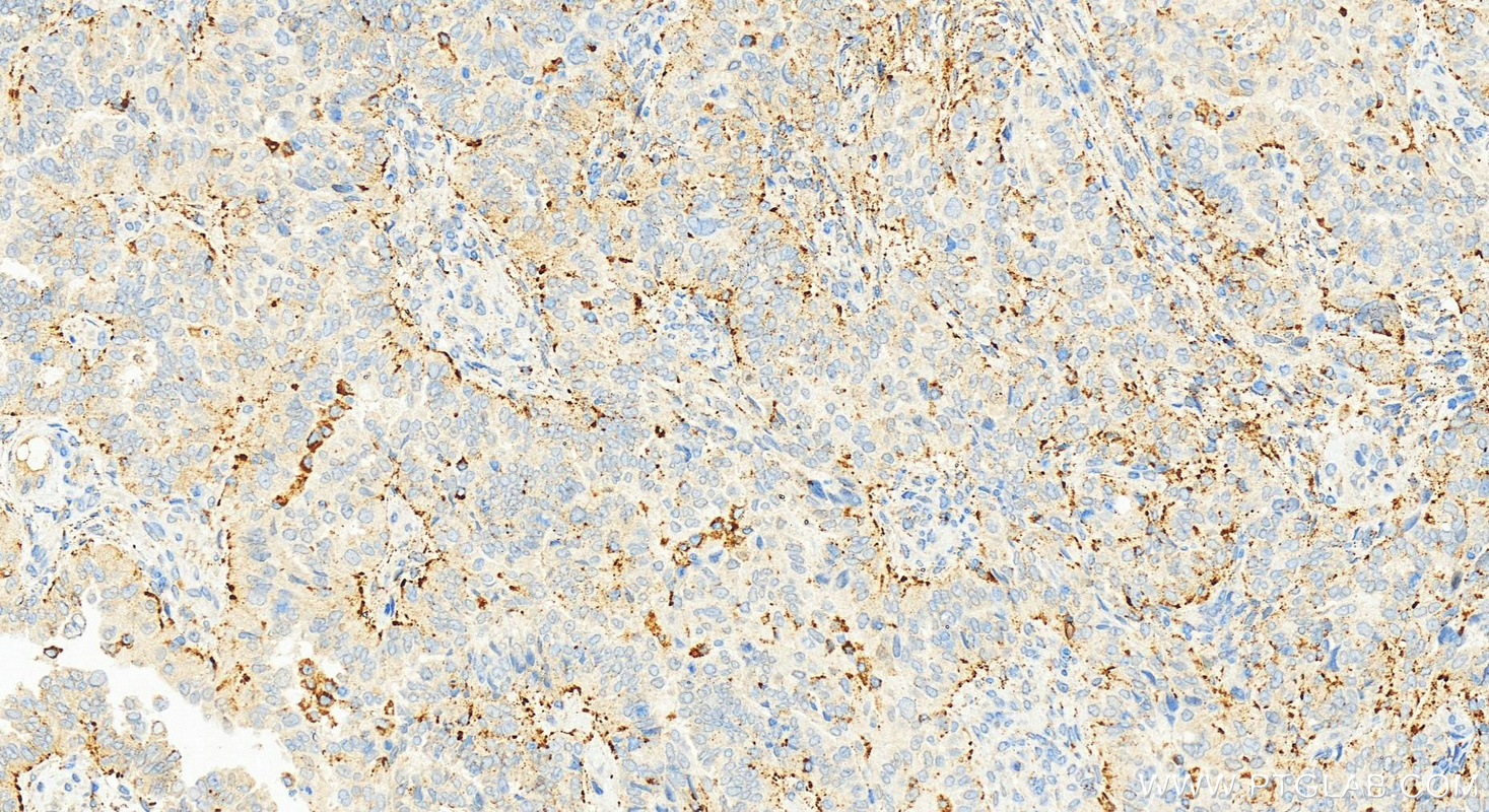 IHC staining of human ovarian  cancer using 83136-3-RR