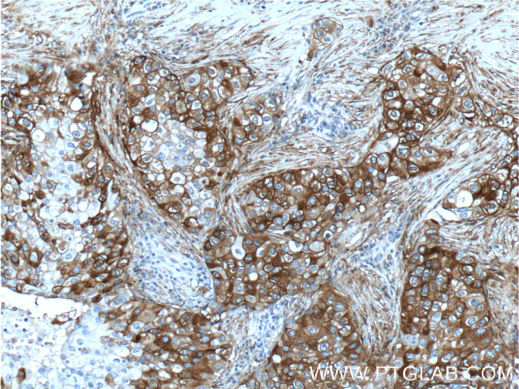 IHC staining of human breast cancer using 11093-1-AP