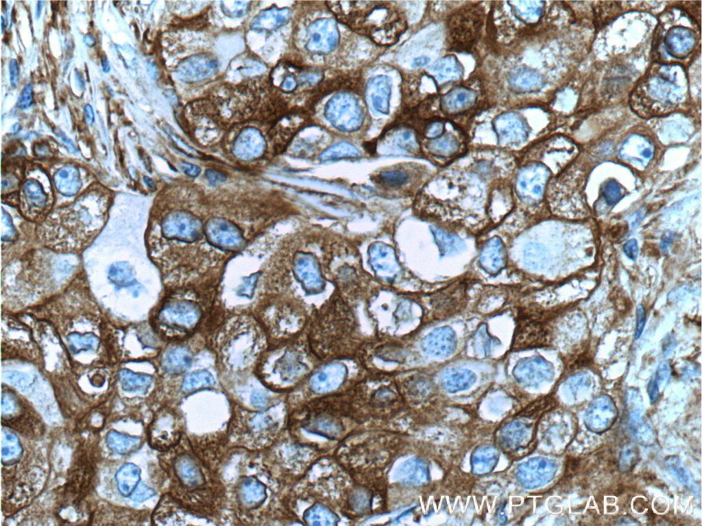 IHC staining of human breast cancer using 11093-1-AP