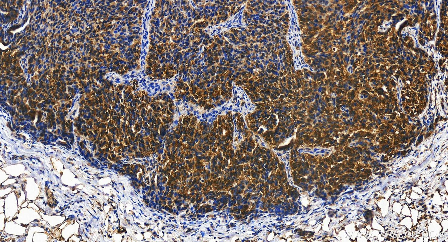 IHC staining of human ovary cancer using 19826-1-AP