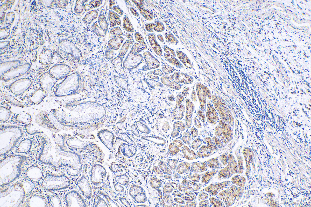 IHC staining of human stomach cancer using 29520-1-AP