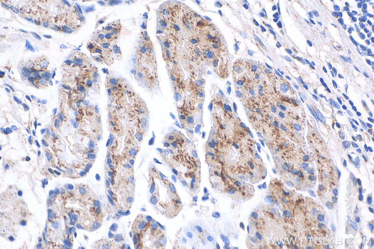 IHC staining of human stomach cancer using 29520-1-AP