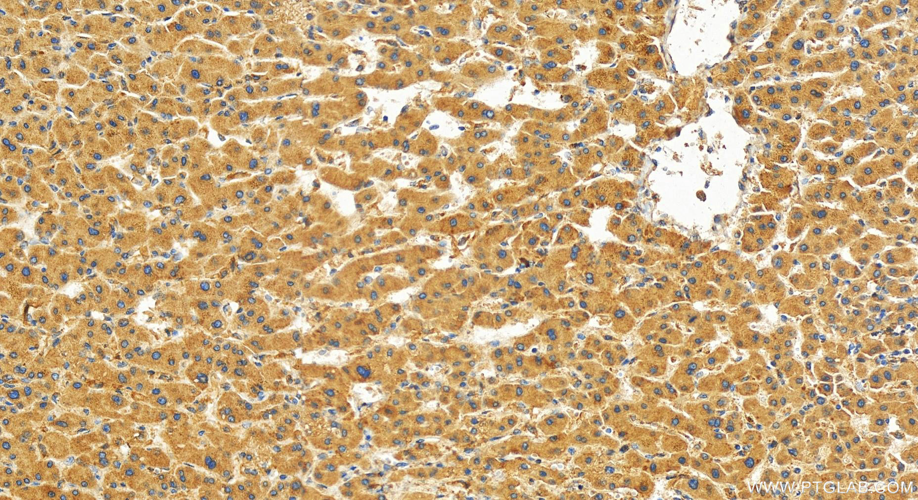 IHC staining of human intrahepatic cholangiocarcinoma using 27757-1-AP