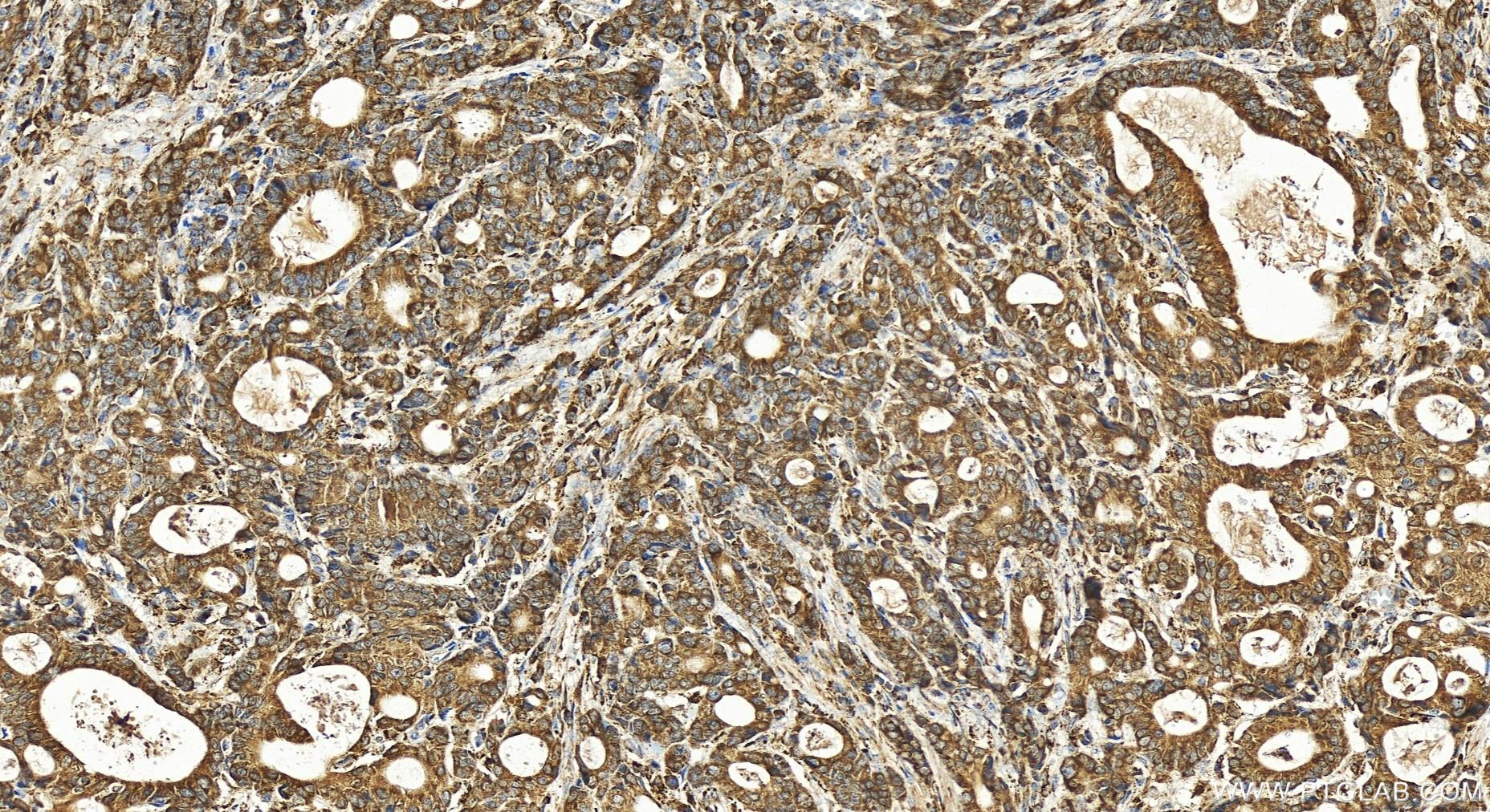 IHC staining of human stomach cancer using 21902-1-AP