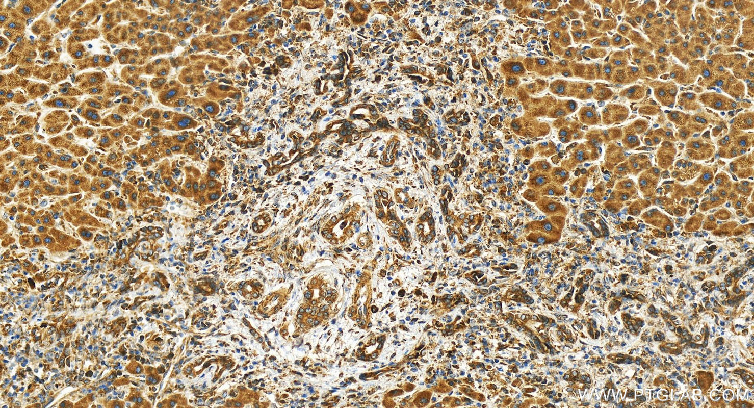 IHC staining of human intrahepatic cholangiocarcinoma using 24645-1-AP