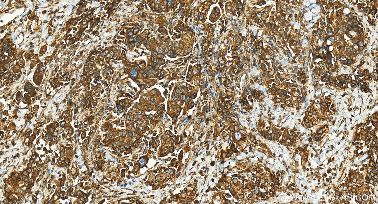 IHC staining of human ovary cancer using 24645-1-AP