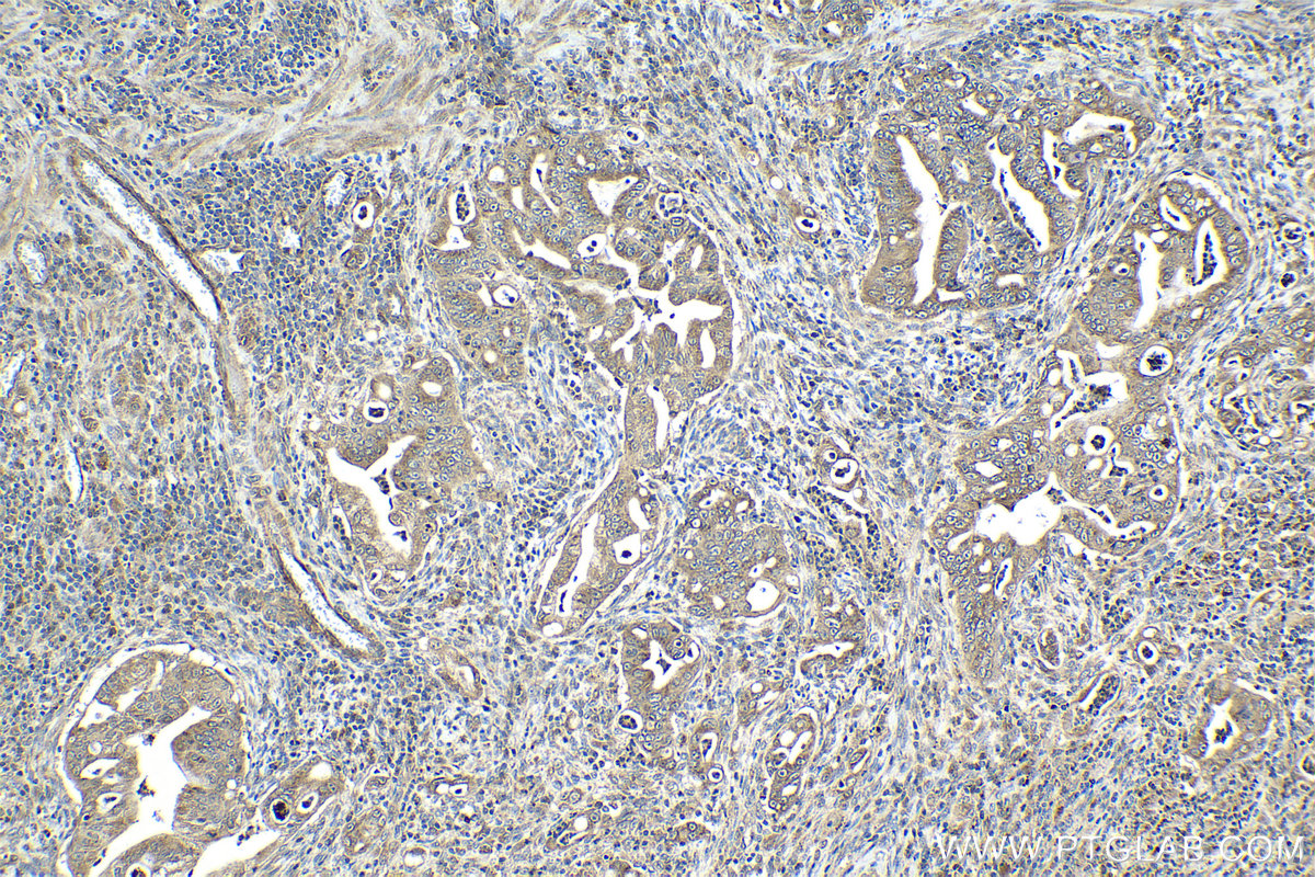 IHC staining of human stomach cancer using 23142-1-AP