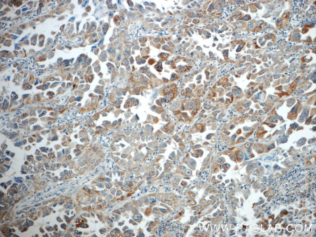 IHC staining of human lung cancer using 21912-1-AP