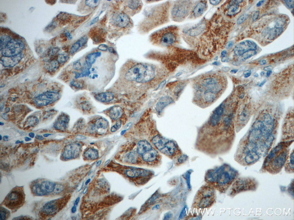 IHC staining of human lung cancer using 21912-1-AP