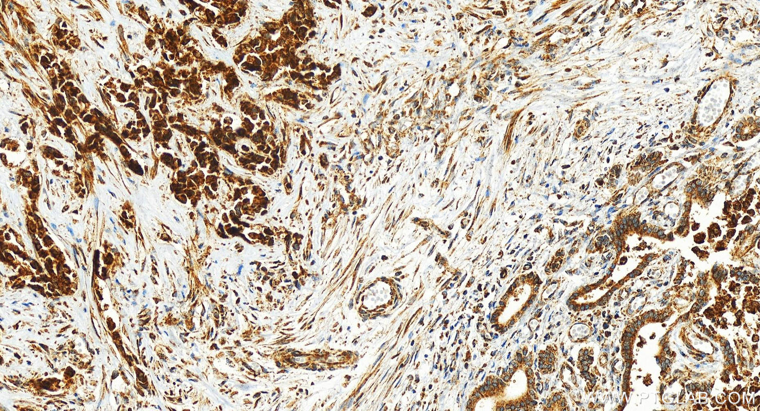 IHC staining of human intrahepatic cholangiocarcinoma using 26451-1-AP