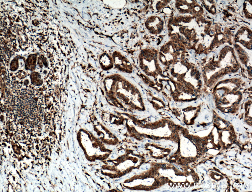 IHC staining of human breast cancer using 24799-1-AP