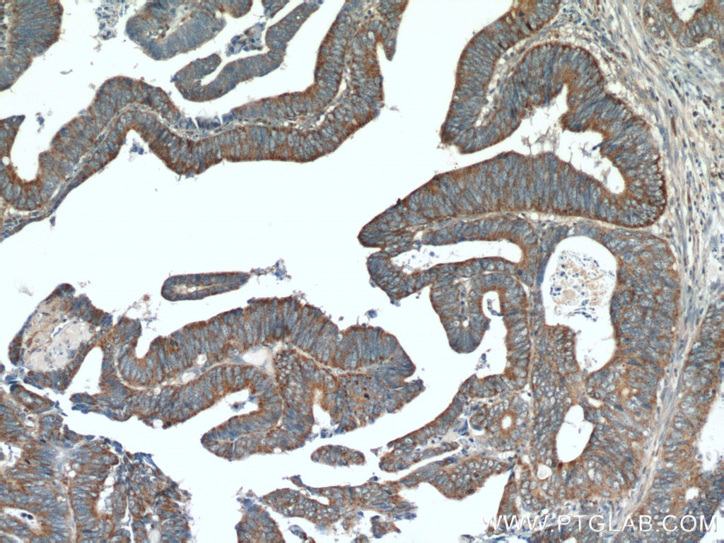 IHC staining of human colon cancer using 25989-1-AP