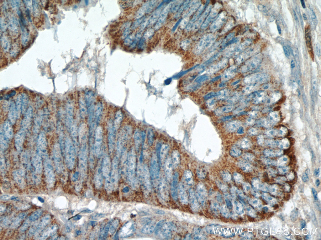 IHC staining of human colon cancer using 25989-1-AP