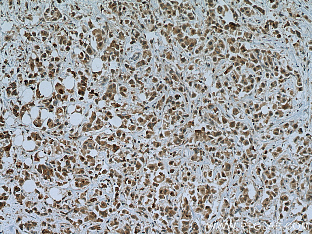 IHC staining of human breast cancer using 20430-1-AP