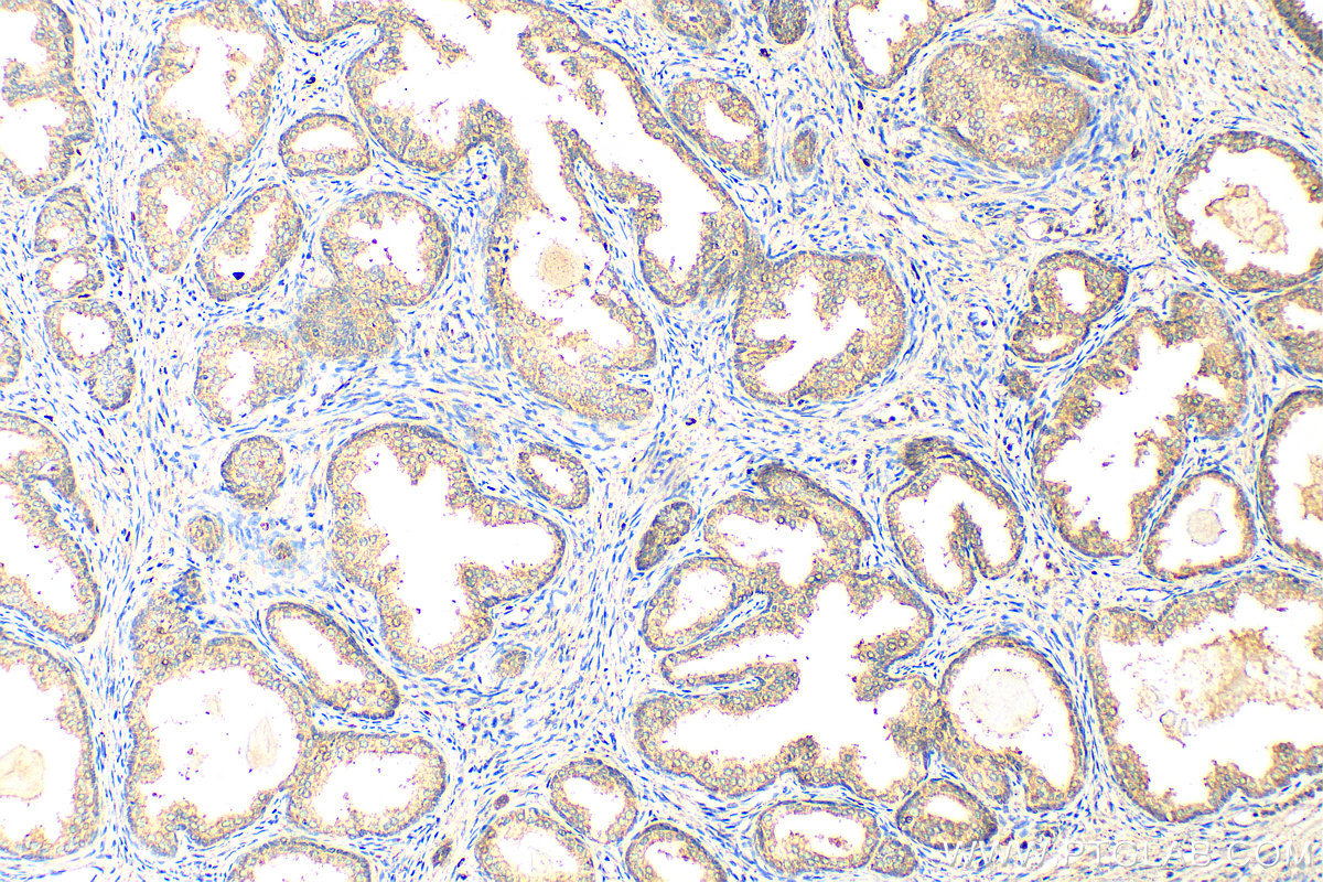 IHC staining of human prostate cancer using 21274-1-AP (same clone as 21274-1-PBS)