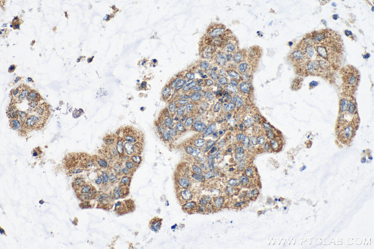 IHC staining of human colon cancer using 21913-1-AP (same clone as 21913-1-PBS)