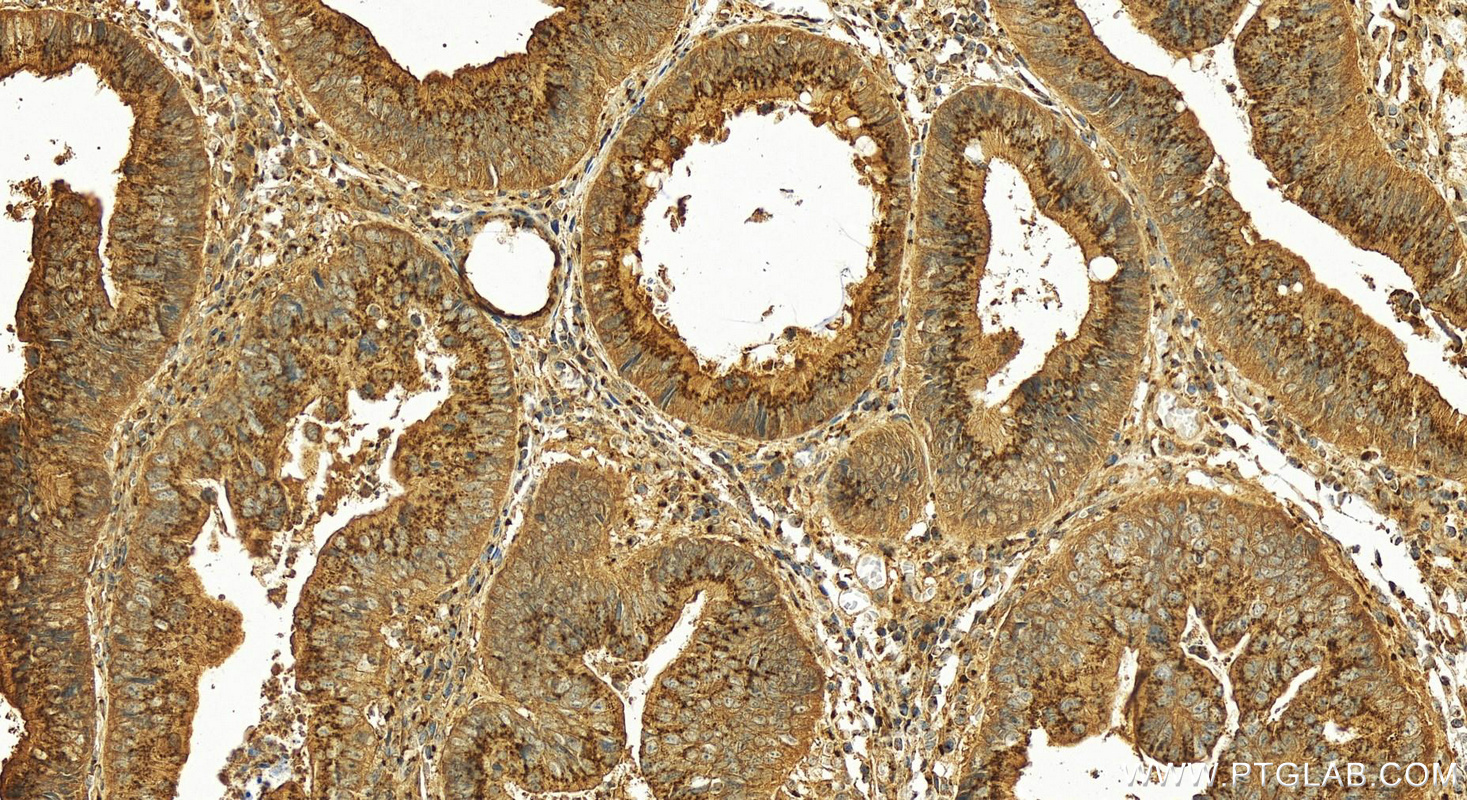 IHC staining of human colon cancer using 22212-1-AP