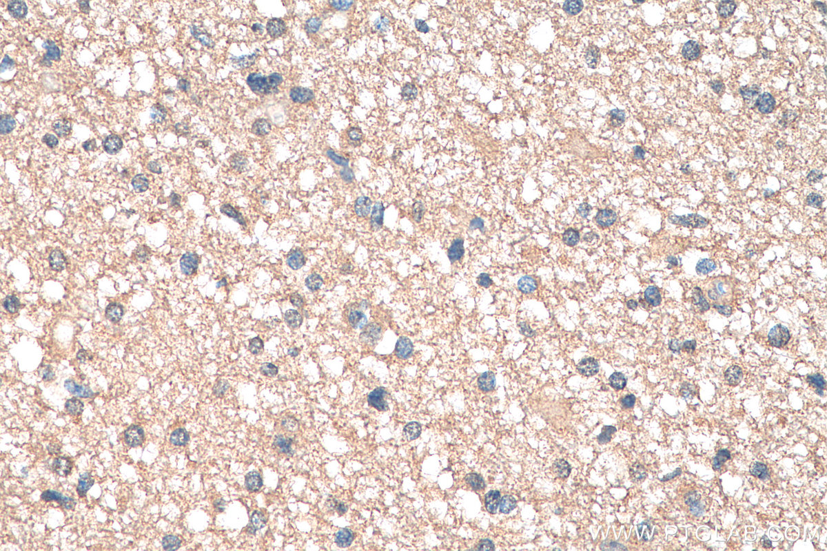 IHC staining of human gliomas using 68039-1-Ig (same clone as 68039-1-PBS)