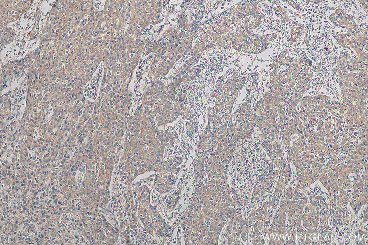 IHC staining of human cervical cancer using 17953-1-AP