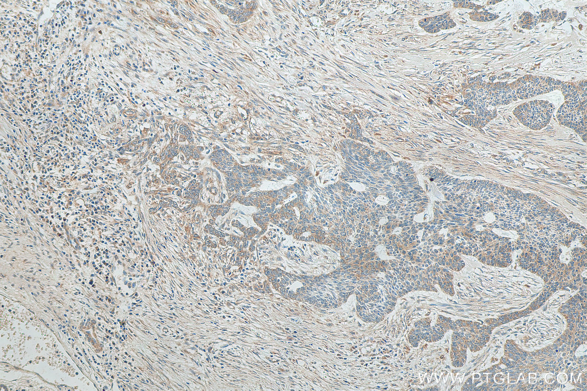 IHC staining of human skin cancer using 17953-1-AP