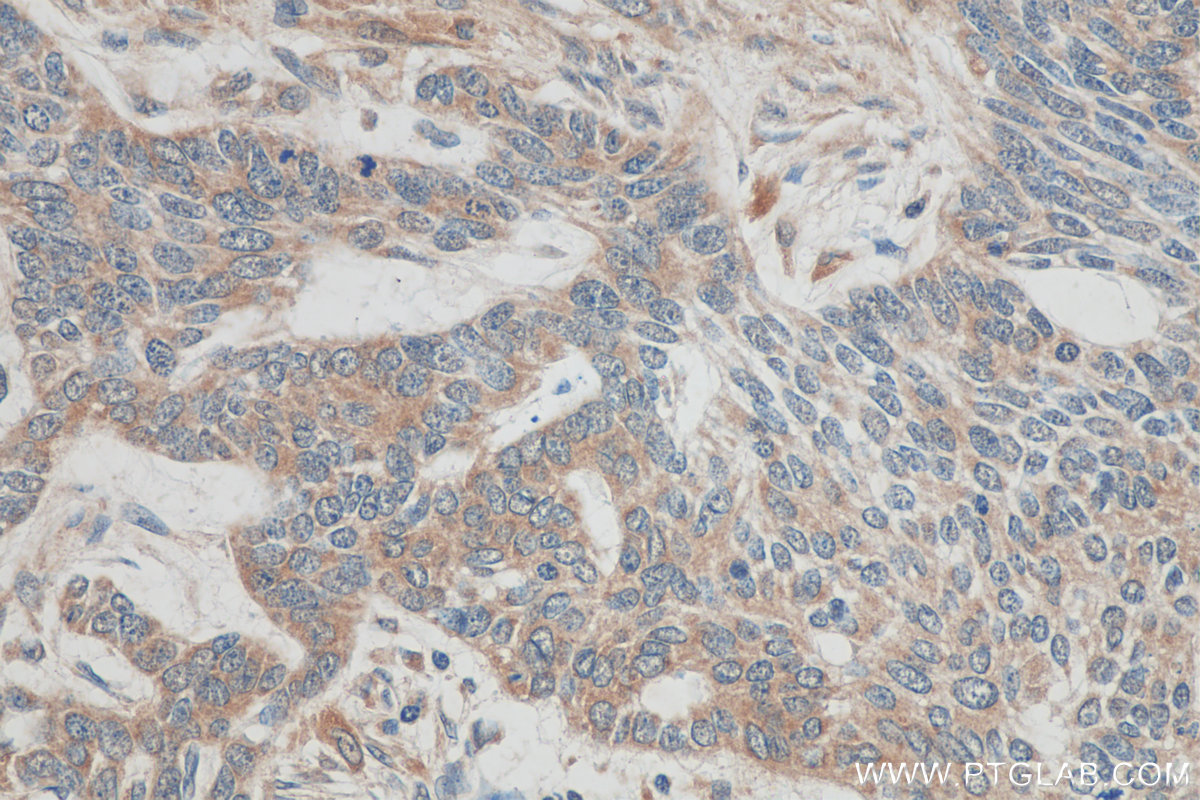 IHC staining of human skin cancer using 17953-1-AP