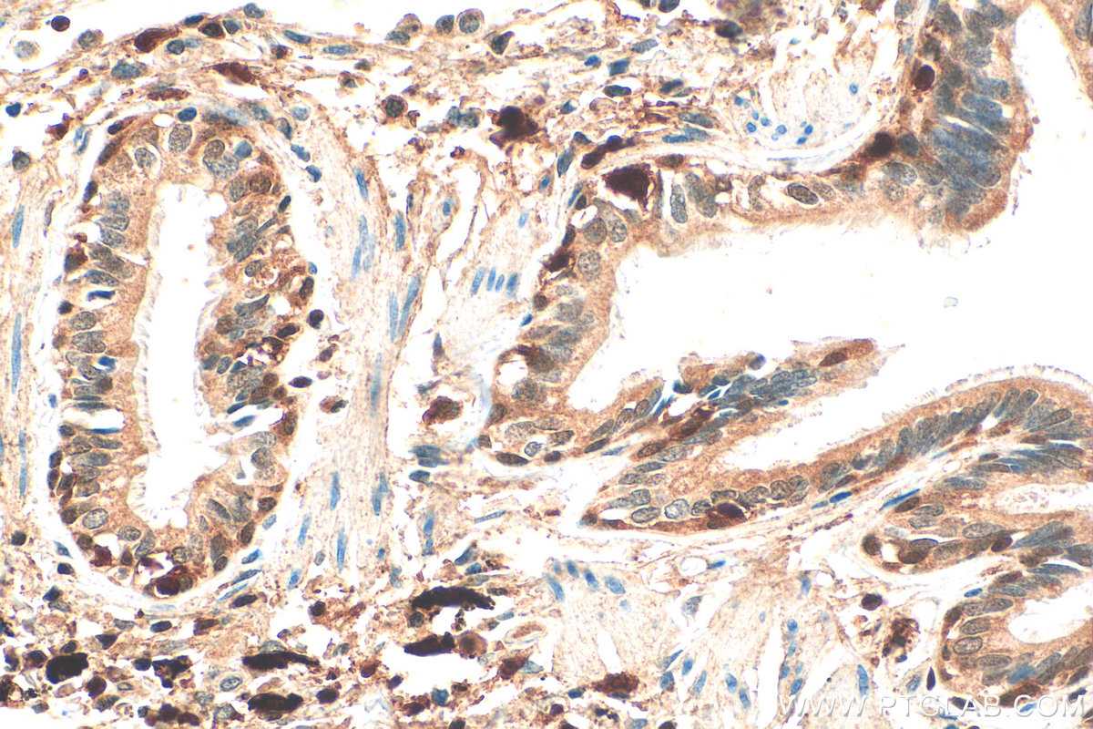 IHC staining of human lung cancer using 10500-1-AP