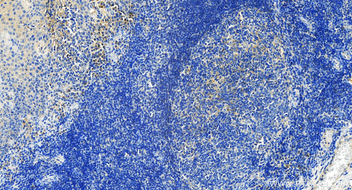 IHC staining of human tonsillitis using 26405-1-AP