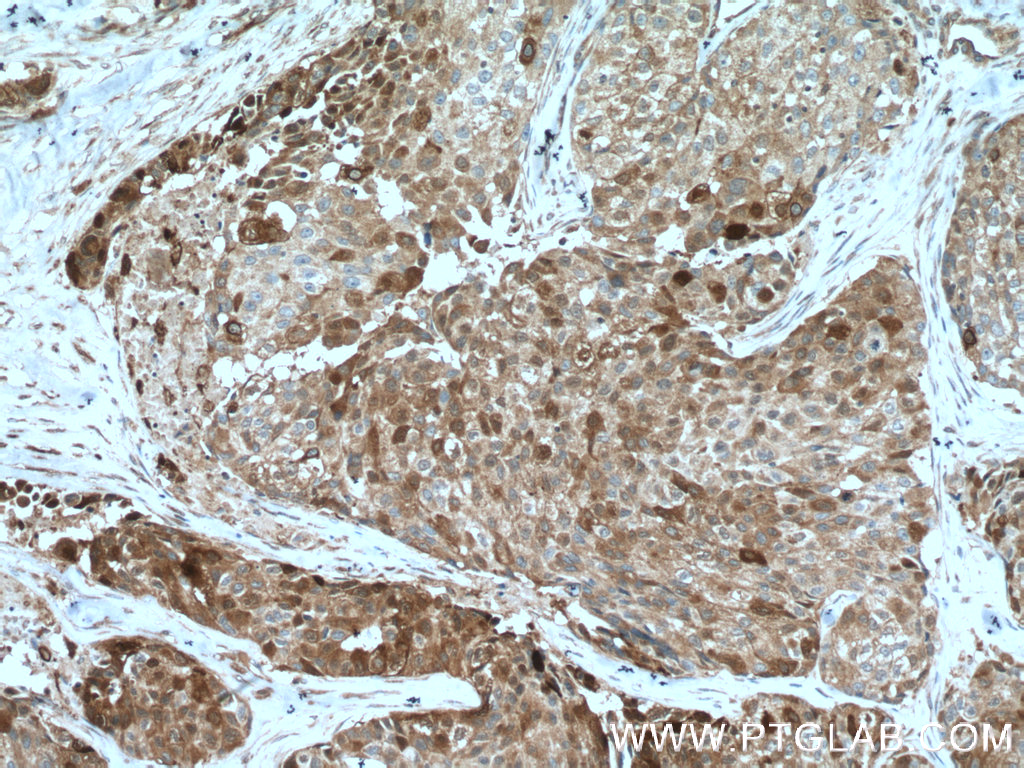 IHC staining of human lung cancer using 60327-1-Ig (same clone as 60327-1-PBS)