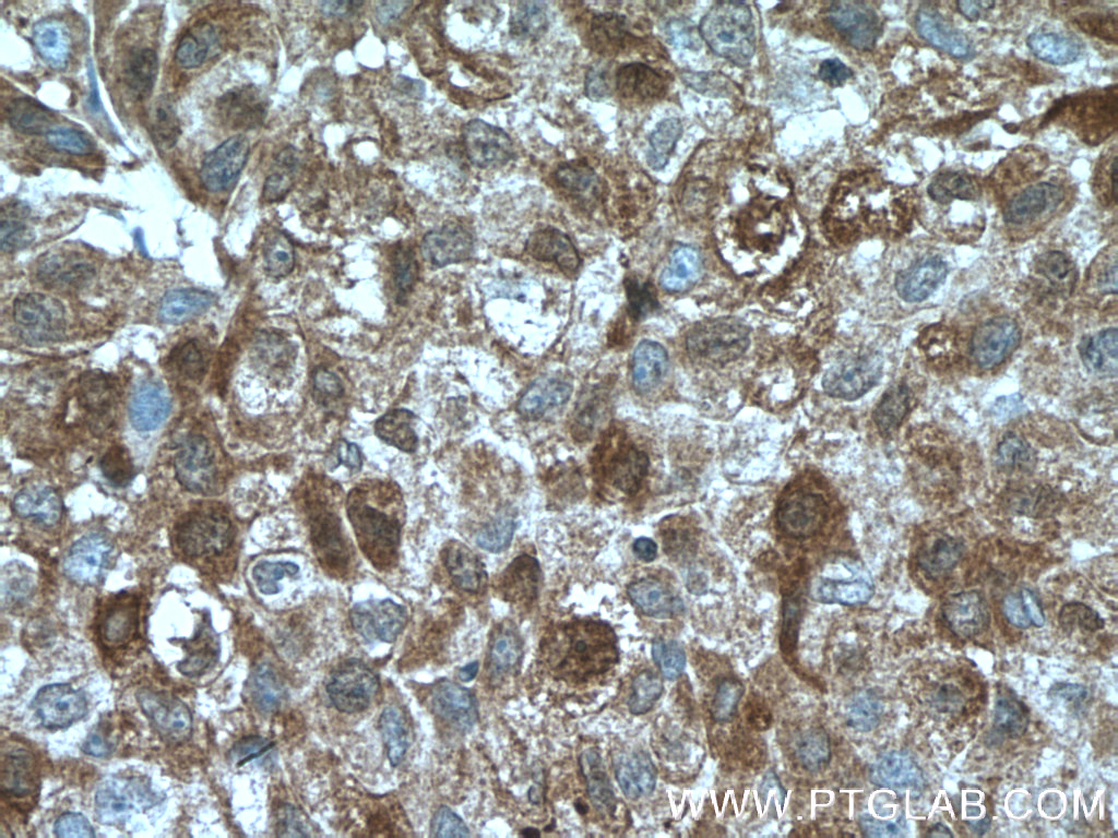 IHC staining of human lung cancer using 60327-1-Ig (same clone as 60327-1-PBS)