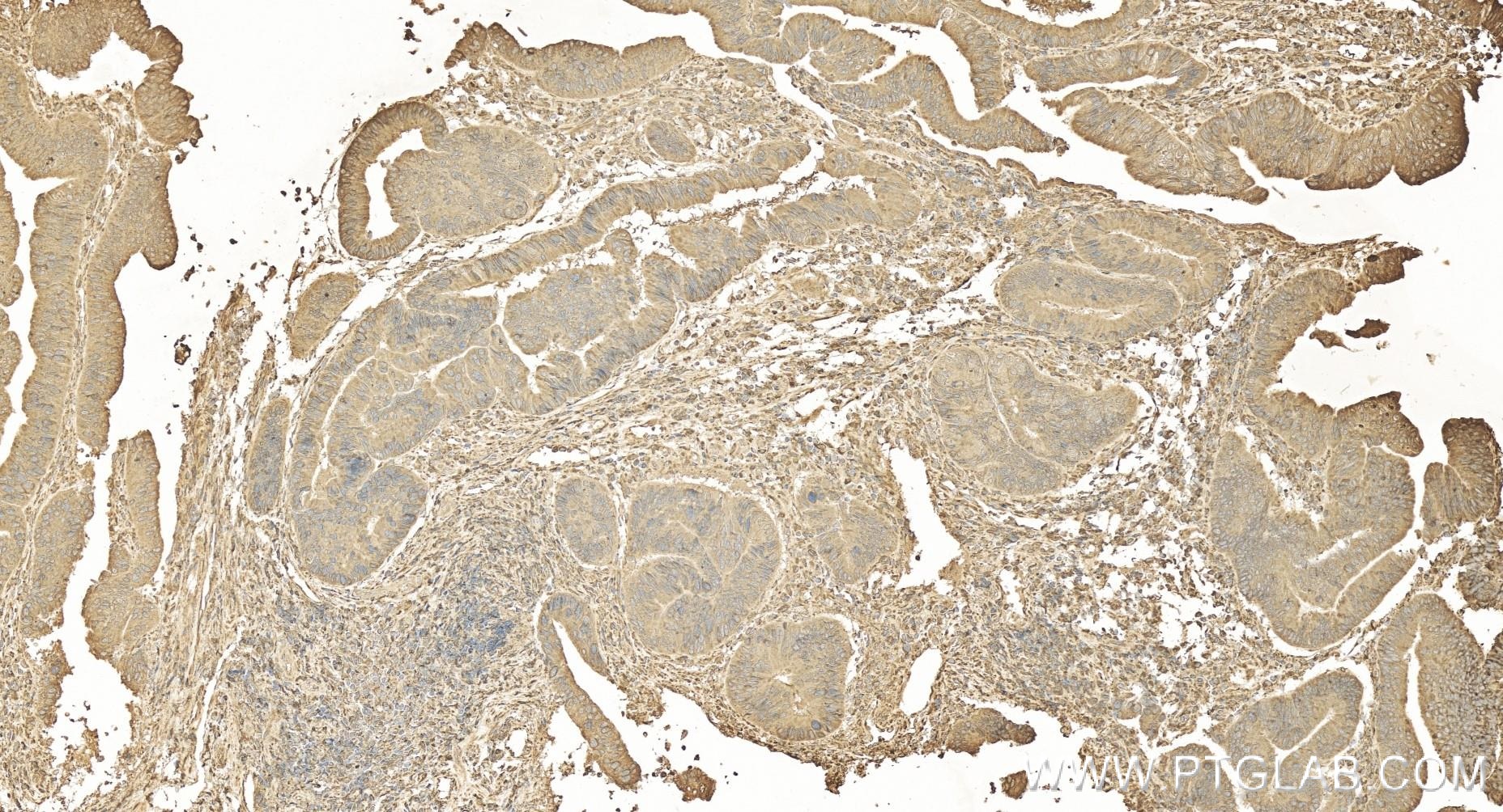 IHC staining of human colon cancer using 84243-5-RR